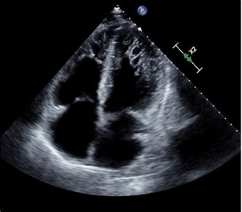 lv ejection fraction 55-60|ejection fraction echo 55 60.